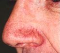 Före IPL-behandling Före IPL-behandling